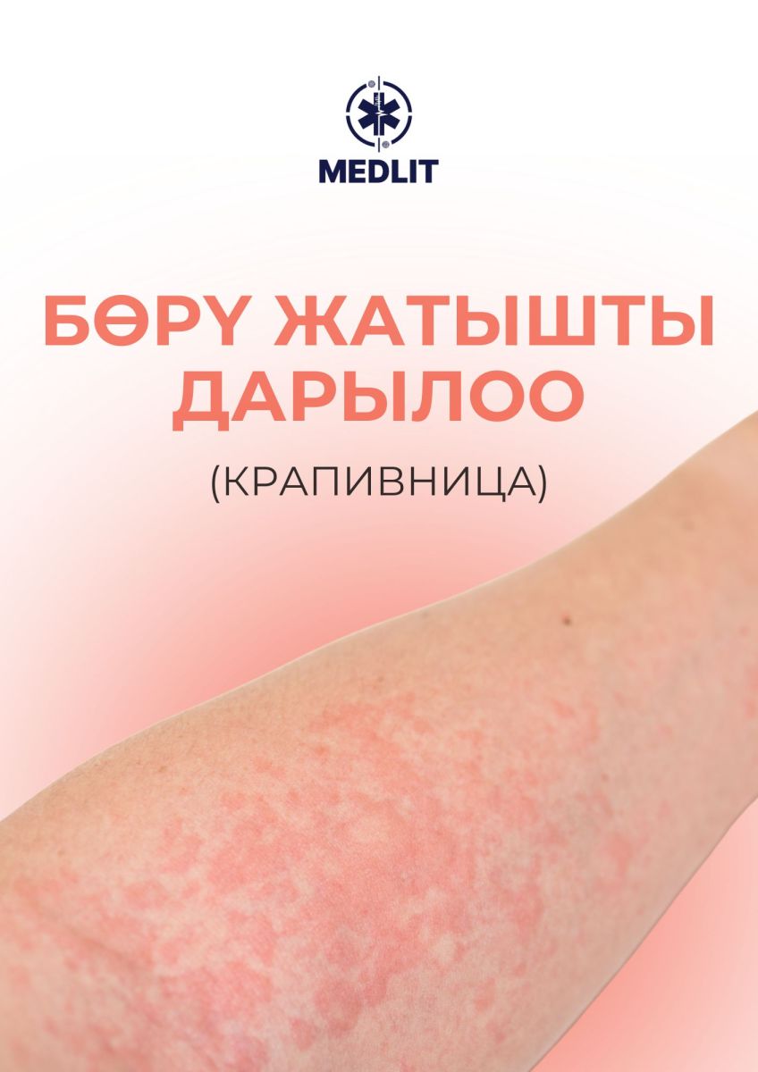БӨРҮ ЖАТЫШТЫ ДАРЫЛОО (КРАПИВНИЦА)