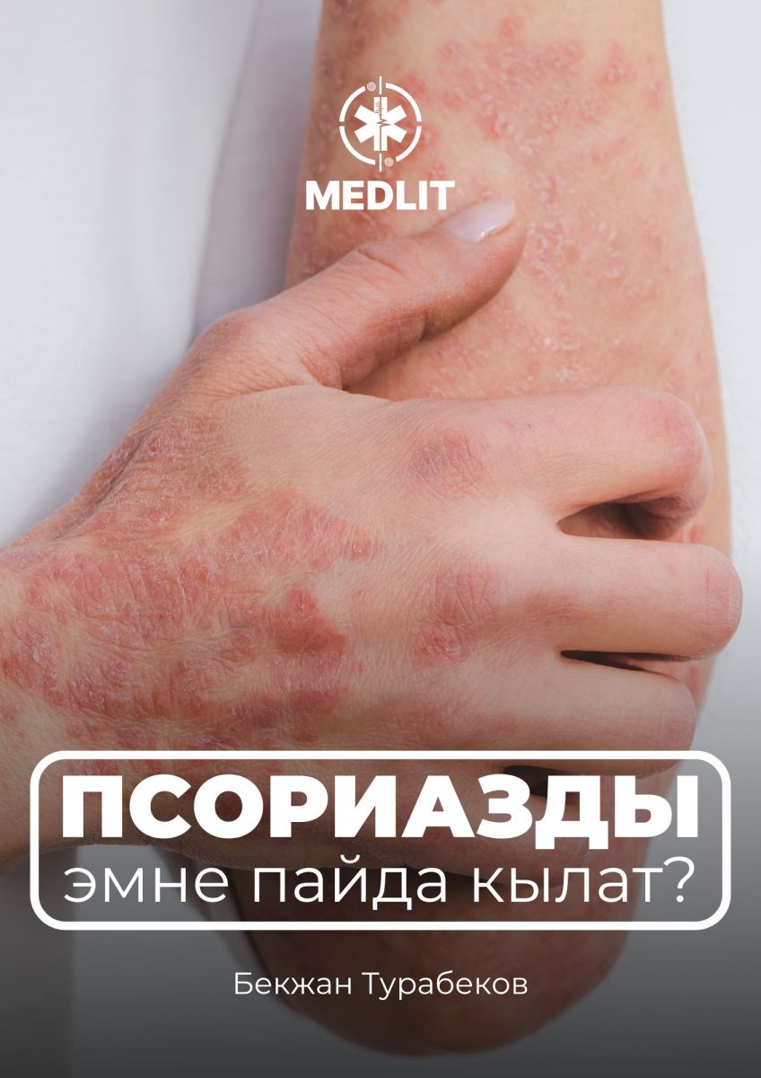 ПСОРИАЗДЫН НЕГИЗГИ СЕБЕБИ
